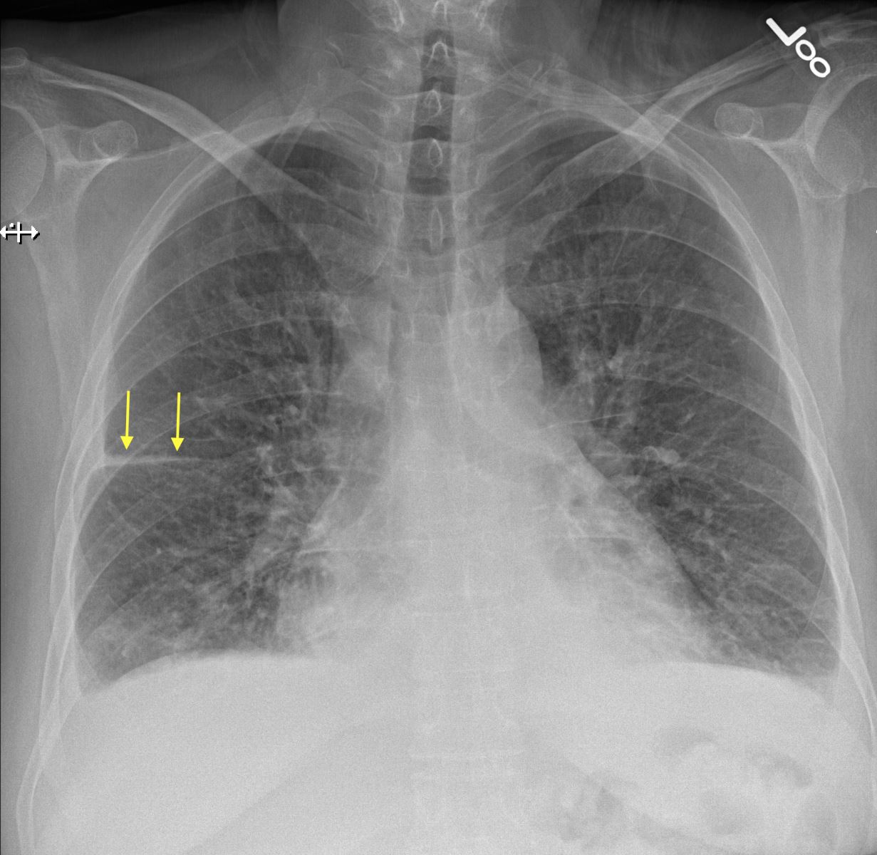 here-are-some-examples-of-fluid-in-the-fissure